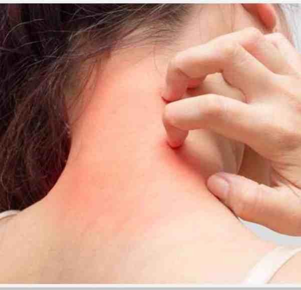 Alergia à bijuterias e semijoias: o que fazer? - Alergia 2 Mulher com alergia - alergia à bijuterias e semijoias: o que fazer?