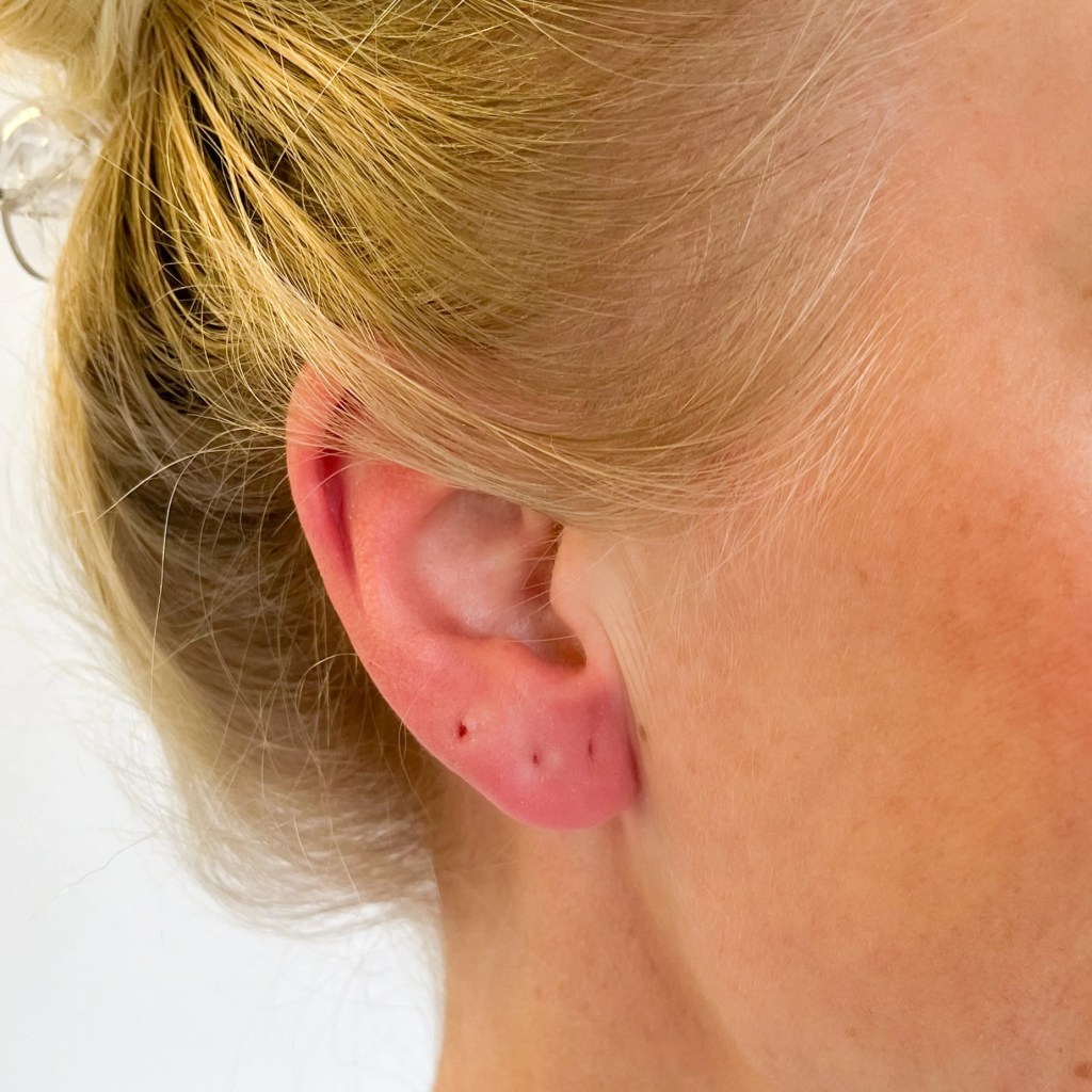 Foto de orelha avermelhada por alergia a brincos, a moça da imagem possui três furos na orelha